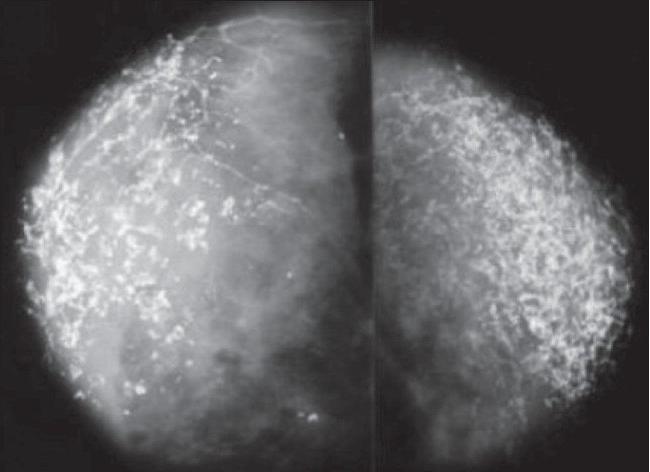 Disseminated microcalcinates in the mammary gland