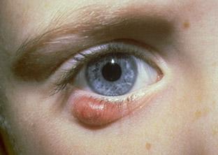 miežių akių gydymo tepalas