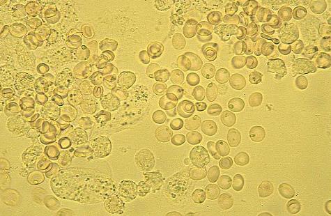 glóbulos vermelhos na urina de uma criança