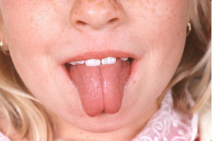 Geschwollene Zunge nach einer Punktion, Foto