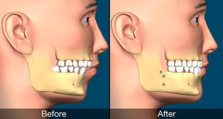 chirurgia ortognatyczna przed i po zabiegu