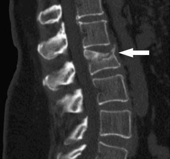 fracture of the spine photo