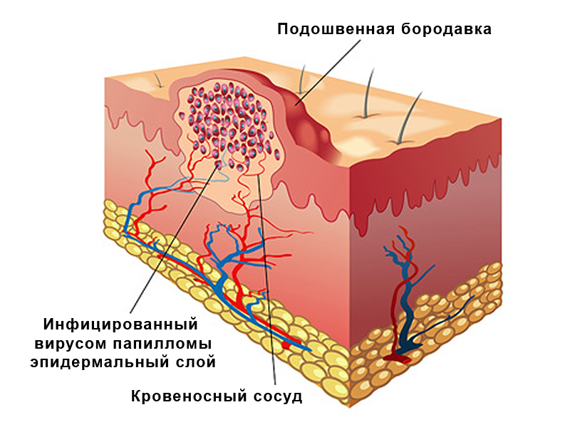 подошвенная бородавка