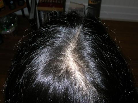 pérdida de cabello difusa de etiología no hormonal