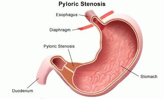 pylorus spasmen 