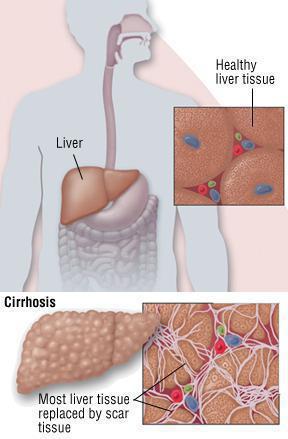 znakovi hepatitisa C kod muškaraca