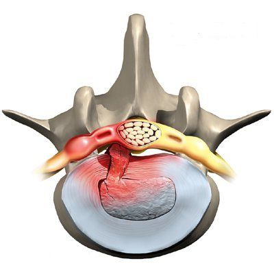 herniovaný disk C5 C6