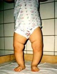 the first signs of rickets in infants