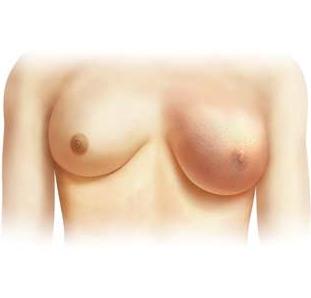 operacija raka dojke