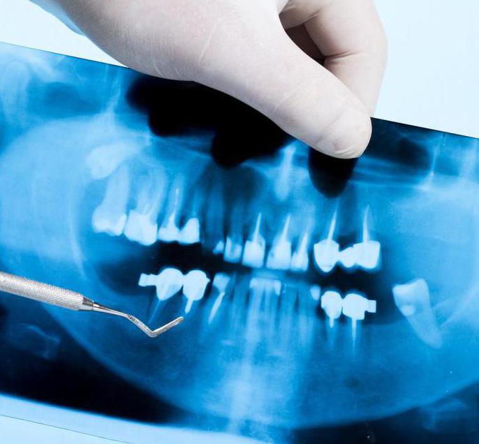 radiografia della mascella superiore