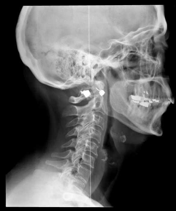 head x-ray showing