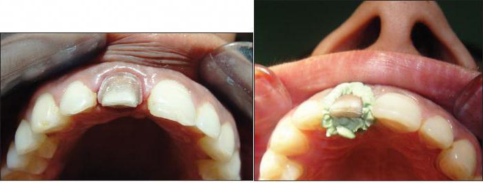 gingivale retractie is in de orthopedie 