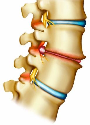 spondylosis wat is het 