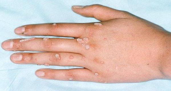 lijek za papilome saonice kože recenzije 