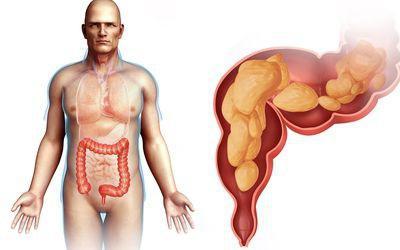 impaired rectal function