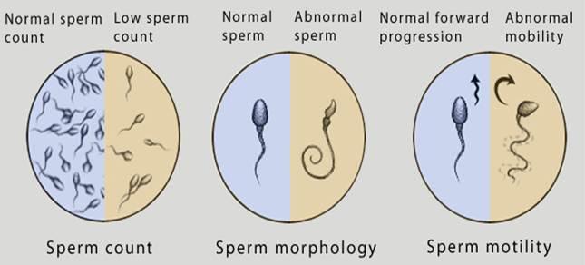 diagnosi di teratozoospermia