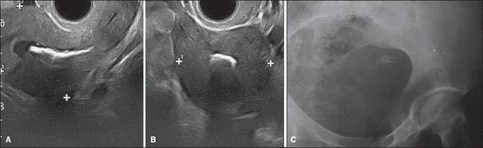 endometrium 10 mm je normálne