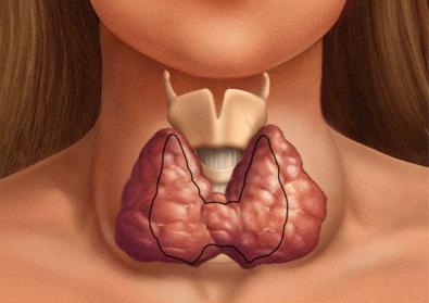 ผลที่ตามมาหลังจากการกำจัดต่อมไทรอยด์