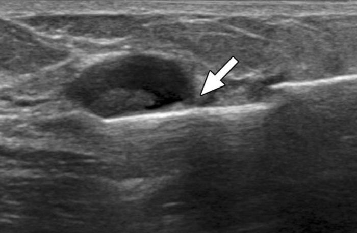 Ultra-som de cistos de glândulas mamárias