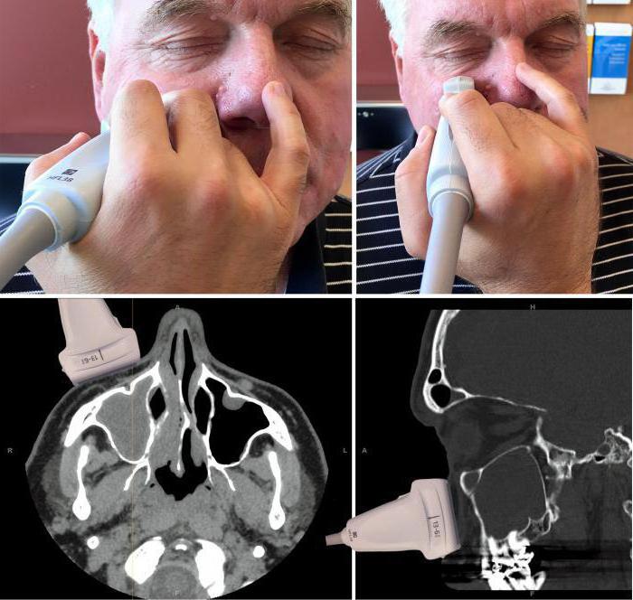 echografie van de sinussen die wordt weergegeven