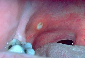 Stomatitis than to treat medications