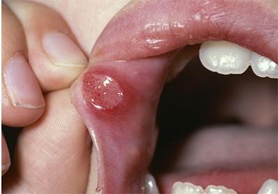 أمراض فطرية لعلاج تجويف الفم