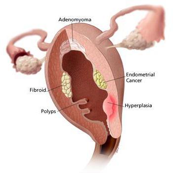 endometrial hyperplasi etter curettage