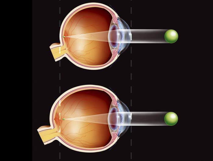 вітамінні краплі для очей які краще при глаукомі