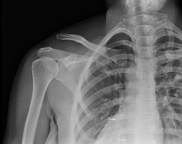 clavicle dislokasjonsbehandling