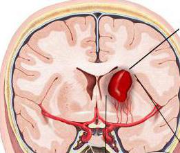 intrakraniellt hematom symptom