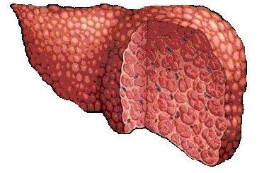 fet hepatose hva er det