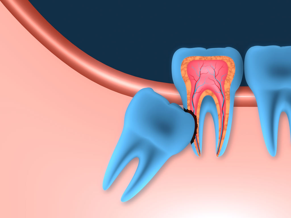 um dente do siso está sendo cortado