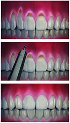 歯茎が歯の治療から遠ざかる